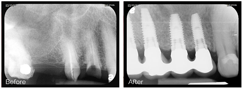ann kearney astolfi bethlehem PA smile gallery Before and After Denta Implants