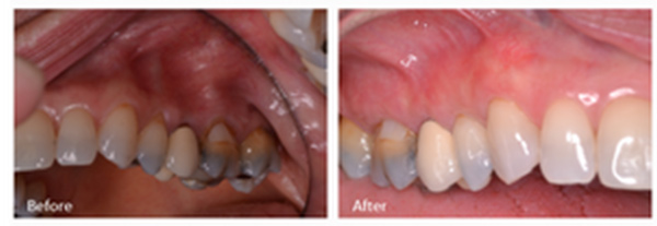 ann kearney astolfi bethlehem PA smile gallery Before and After sinus lift